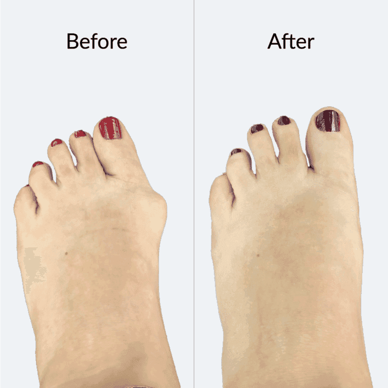 Minimally Invasive Bunion Correction Dr. Mugrabi Clinic