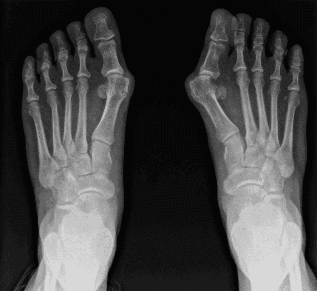 Minimally Invasive Bunion Correction Dr. Mugrabi Clinic
